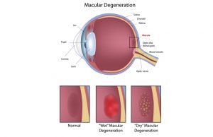 Macular Degeneration