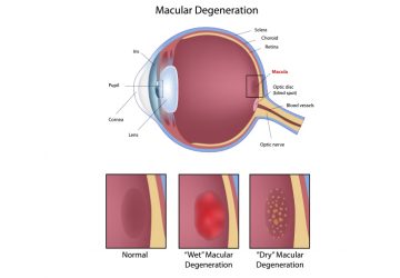 Macular Degeneration