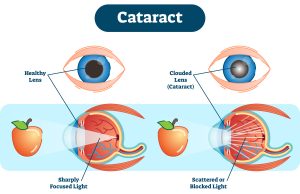 Cataract