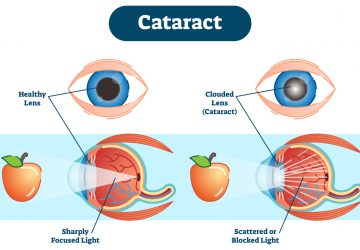 Cataract