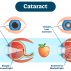 Cataract