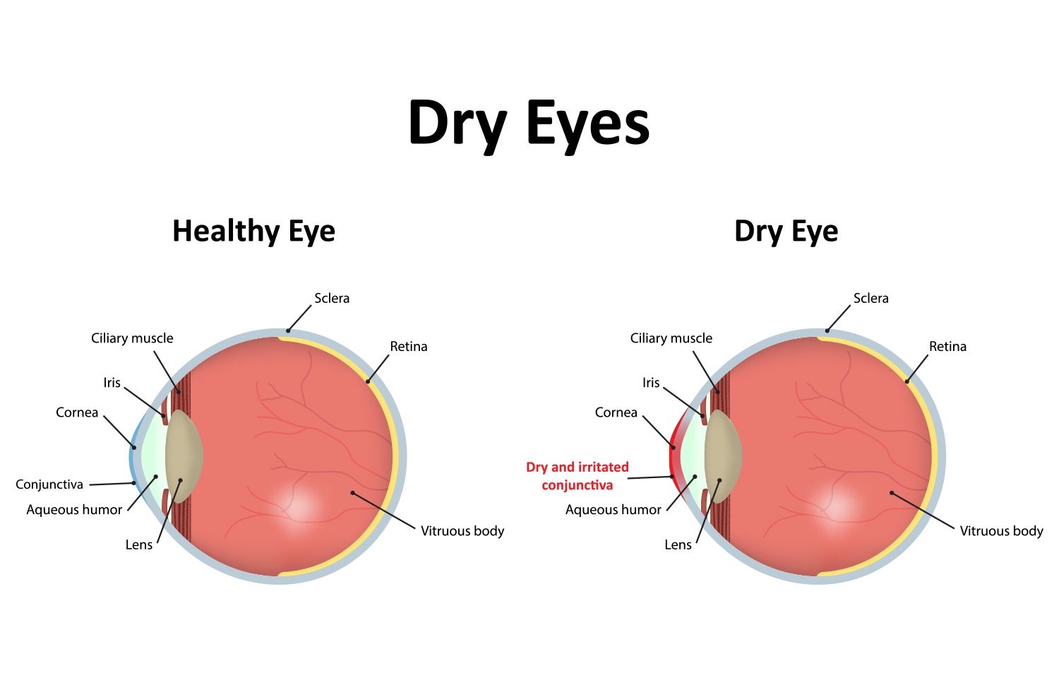 Dry Eyes Passano Opticians
