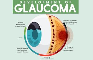 What is Glaucoma