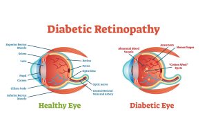 Diabetic Retinopathy